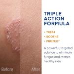 Hermon Antifungal Cream for Ringworm and Skin Issues