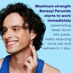 Acne Spot Treatment Gel with 10% Benzoyl Peroxide