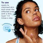 Acne Spot Treatment Gel with 10% Benzoyl Peroxide