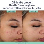 Cetaphil Acne Moisturizer with Salicylic Acid