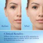 Differin Acne Treatment Gel - Affordable Solution