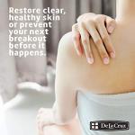 De La Cruz 10% Sulfur Ointment for Acne