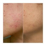 Ogee Plant-Based Acne Treatment for Face with Salicylic Acid - Targeted Acne Spot Treatment with Soothing Ceramic Application Tip