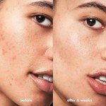 e.l.f. SKIN Vegan Blemish Control Kit