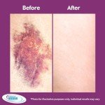 Extra Strength Arnica Cream for Bruising Relief