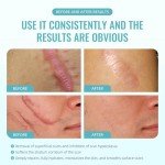 Scar Cream Gel for Surgical Scars & More