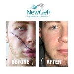 Advanced Silicone Scar Gel with Vitamin E, 15g