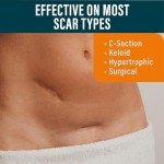 Silicone Patches for Scar Reduction – 14.5 x 4 cm
