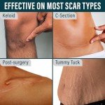 NUVADERMIS Medical Silicone Scar Tape - Extra Long