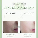 Centella Gel Cream for Acne-Prone Skin
