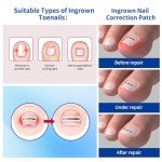 Titanium Alloy Ingrown Toenail Correction Kit
