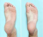 Corn and Callus Trimmer Refills - 4 Pack