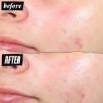Kiehl's Acne Spot Treatment Pimple Patch 0.5 fl oz