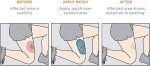 KT Tape Recovery+ Patch for Swelling Relief