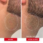 Organic Ingrown Hair Treatment Pads with BHA & AHA