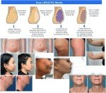 Lipolytic Lipolysis Solution - 5 Vial Pack
