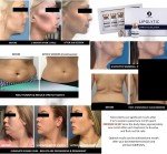 Lipolytic Lipolysis Solution - 5 Vial Pack