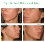 Glycolic Acid Face Peel Kit for Acne and Aging