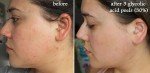 Glycolic Acid Face Peel Kit for Acne and Aging
