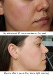 Glycolic Acid Face Peel Kit for Acne and Aging