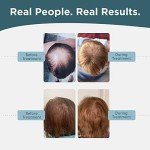 Shapiro MD Hair Growth Experts Minoxidil 5% Topical Solution for Mens Hair Growth, Serum Promotes Hair Regrowth by Reactivating Hair Follicles, 2 Month