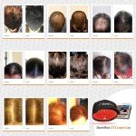 illumiflow 272 Laser Cap for Hair Growth - FDA Cleared Low Level Laser Therapy Hair Regrowth System for Men & Women - Hair & Scalp LLLT Hat w/Lasers Stops Hair Loss & Regrows Thinning Hair