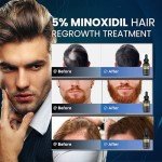5% Minoxidil Hair Growth for Men and Women: Biotin Hair Growth Serum for Hair Loss, Thinning, and Faster Regrowth Treatment - 60ML