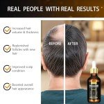 2-Pack 5% Minoxidil Hair Growth Serum for Men and Women, Hair Regrowth Treatment for Stronger, Thicker, and Longer Hair, Facial Hair Grooming and Thickening Solution