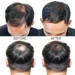 Hair-Regen Advanced 5% Minoxidil For Men Hair Regrowth Treatment for Thinning Hair - Hair Loss for Men - 6 Month Supply, Minoxidil Topical Solution So Thicker Fuller Hair Keeps Growing Amazing Results