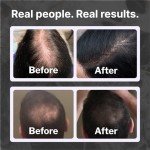 Shapiro MD Hair Growth Experts Hair Loss Shampoo | DHT Fighting Vegan Formula for Thinning Hair Developed by Dermatologists | Experience Healthier, Fuller and Thicker Looking Hair | 1 Month Supply