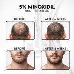 Kings Topical 5% Minoxidil for Men Alcohol-Free Formula - Fights Thinning, Male Pattern & Hereditary Hair Loss - High Absorption Subcutaneous Regrowth Solution, 60ml
