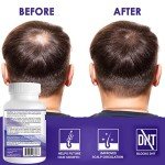 Propidren by HairGenics - DHT Blocker & Hair Growth Capsules to Prevent Hair Loss & Stimulate Hair Follicles, to Stop Hair Loss & Regrow Hair. Proprietary Anti-Hair Loss & Hair Regrowth Treatment.