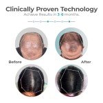 Capillus Ultra Mobile Laser Therapy Cap for Hair Regrowth, with 82 Red Light Lasers for Laser Hair Growth, Red Light Hair Growth