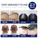Laser Hair Growth Cap, Red Light Therapy Cap, Low Level Laser Therapy (LLLT) Equipment for Promoting Hair Growth in Women and Men（Black）