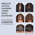 Hairmax Laser Cap 272 (FDA Cleared), RegrowMD, Improved Battery Design, Hair Loss Treatment for Men & Women, 100% Medical Grade Lasers Full Scalp Coverage For Thinning Hair & Balding
