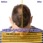 5% Minoxidil Foam for Hair Growth and Thickening - Biotin & Minoxidil Treatment to Stop Thinning & Hair Loss for Men & Women, 2oz