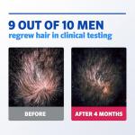 Men’s Rogaine 5% Minoxidil Topical Foam, One Month Supply
