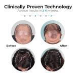 Capillus ONE Laser Cap for Hair Growth