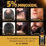 5% Minoxidil Hair Growth Serum Oil For Men and Women, Biotin Hair Serum, Safest Hair Regrowth Treatment, Prevent Scalp Hair Loss 60ml / 2.11 fl.oz