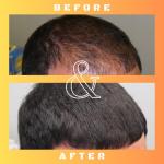 Mane Regain - RU58841 5% Solution (50mg/ml) - DHT Blocker - Advanced Hair Loss Treatment - Anti-Androgen Hair Tonic - Promotes Hair Regrowth and Prevents Male Pattern Baldness - 30ml