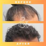 Mane Regain - RU58841 5% Solution (50mg/ml) - DHT Blocker - Advanced Hair Loss Treatment - Anti-Androgen Hair Tonic - Promotes Hair Regrowth and Prevents Male Pattern Baldness - 30ml