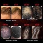 REVIAN Lyte Cap Hair Growth Device LED Wireless FDA Cleared Red Light Therapy, Hair Loss Treatment for Men + Women, Thinning, Regrowth & Alopecia