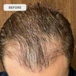 Kiierr 272 MD Laser Cap | FDA Cleared Hair Loss Treatment for Men & Women