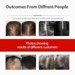 Laser Cap, Portable Red Light Therapy for Hair Growth, Hair Loss Treatments Hat for Men & Women, with Built-in Battery & Controller