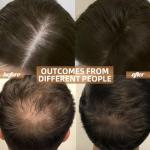 Cordless Red Light Therapy for Hair Growth Cap, Infrared Red Light Therapy to Support Scalp Health, Reduce Hair Loss & Shedding