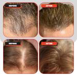 Kiierr 272 Premier Laser Cap | FDA Cleared For Hair Loss In Men & Women | Full Scalp Treatment to Reverse Thinning | 272 Medical Grade Lasers, Not LEDs