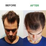 Laser Hair Growth Cap, Laser Hair Growth Cap is Low Level Laser Therapy (LLLT) Device Designed to Promote Hair Growth in Women and Men, Laser Cap Red Light Therapy Cap Laser Therapy Cap