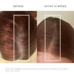 HigherDOSE Red Light Therapy Hat for Hair Growth - Reduce Hair Loss & Shedding - Targeted Infrared Red Light Therapy to Support Scalp Health