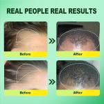 5% Minoxidil for Men, 2PCS Minoxidil for Women Hair Growth Products, Extra Strength Minoxidil Topical Hair Loss Regrowth Treatment Serum with Rosemary & Biotin, Upgraded formula light & Non-Greasy