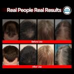 Laser Cap Hair Growth Device - FDA Cleared Red Light Therapy for Hair Regrowth - Effective Treatment for Thinning Hair and Alopecia in Men & Women